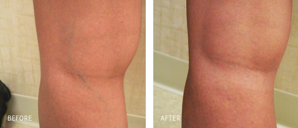 Leg vein Sclerotherapy treatment outcome | Performedby Dr. Dishakjian in Los Angeles