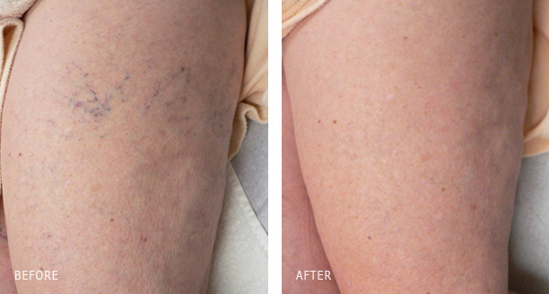 Laser Vein Treatment - Before After Photos Before/After photos of leg spider veins and thread veins treated with a combination of sclerotherapy and lasers by Dr. Dishakjian in his office in Los Angeles.