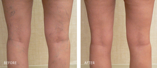 Vein Removal Los Angeles  Best Treatment for Varicose Veins