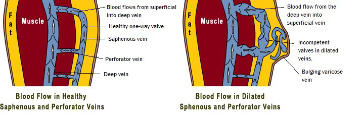 Blood Flow in Healthy Leg Veins Vs Flow in Dilated Leg Veins with Incompetent Valves