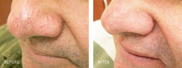 Nose Veins Laser Removal for a patient from Canoga Park.