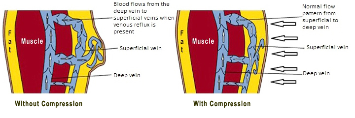 The Effect of Compression on Blood Flow Pattern