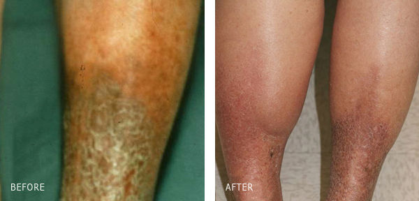 Advanced Venous Stasis Dermatitis - Lipodermatosclerosis