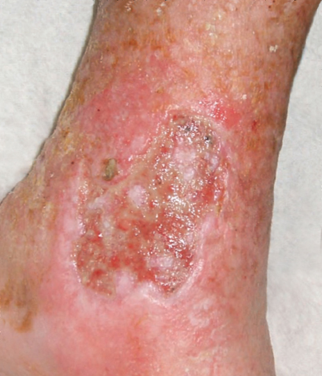 Venous Stasis Ulcer