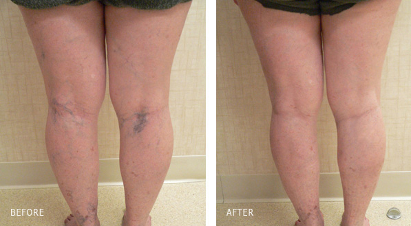 Leg Spider Vein Treatment Los Angles - Before and After Treatment