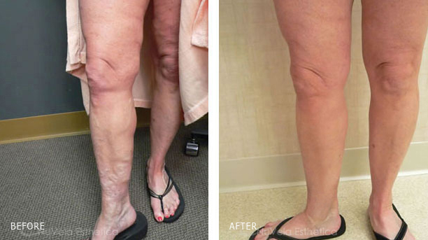 Varicose vein treatment Los Angeles - Before and After Photos