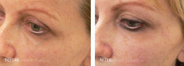 Facial Vein Laser Treatment of a Patient from Los Angeles - Before and After Photos