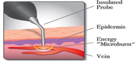 The VeinGogh stylus for facial vein treatment The VeinGogh Stylus for Facial Vein Treatment