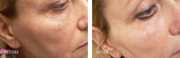 Before/After photos showing the outcome of under eye vein laser removal performed by Dr. Dishakjian in his vein clinic in Los Angeles. Facial reticular vein laser treatment before and after photos