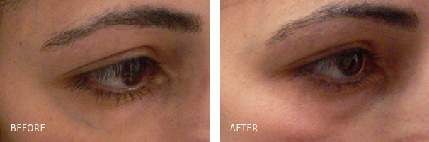 Under eye reticular vein laser removal - Before and After Photos Under-eye reticular vein laser treatment before and after photos